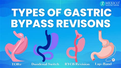 retention mini gastric bypass revision